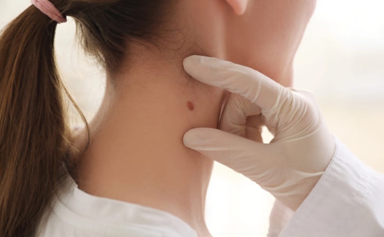 Lagoa recebe rastreio do cancro da pele e oral 